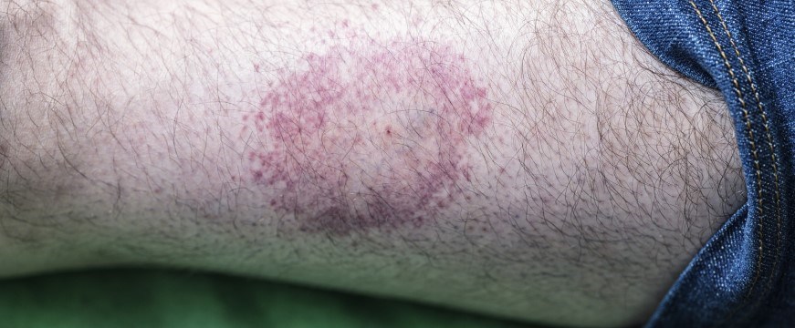 Photo of Lyme disease rash