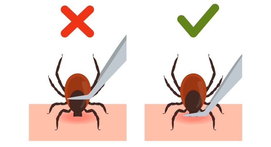 Illustration showing to remove ticks with tweezers near skin and not the body of the tick